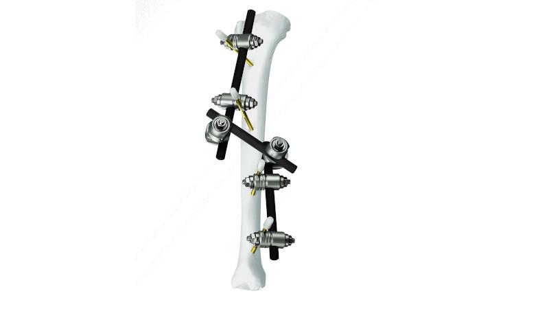 OUTFLOW　BigFree151 Large and Medium External Fixation System | Products | DePuy Synthes